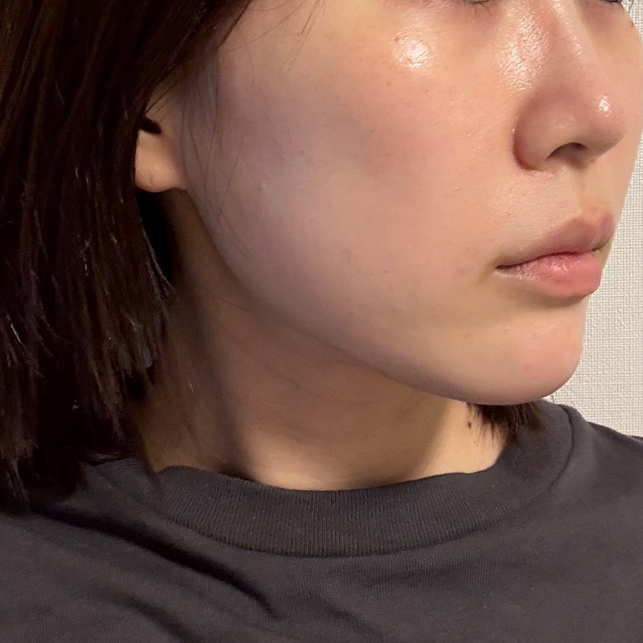 IPL光治療　〜ライムライト🍋‍🟩の口コミ写真