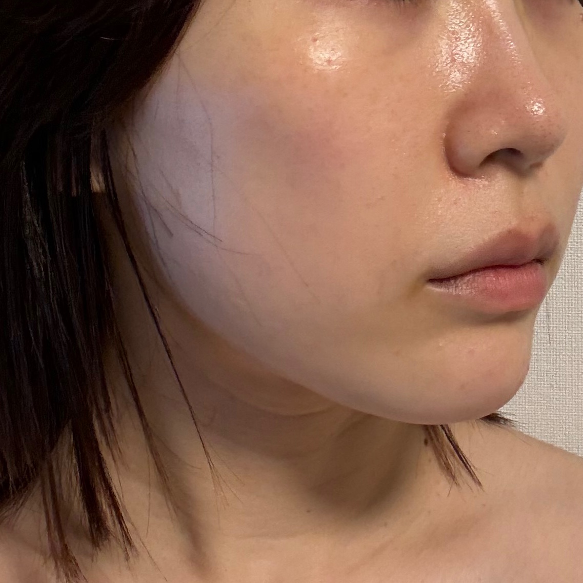 「IPL光治療　〜ライムライト🍋‍🟩」の感想 写真 2