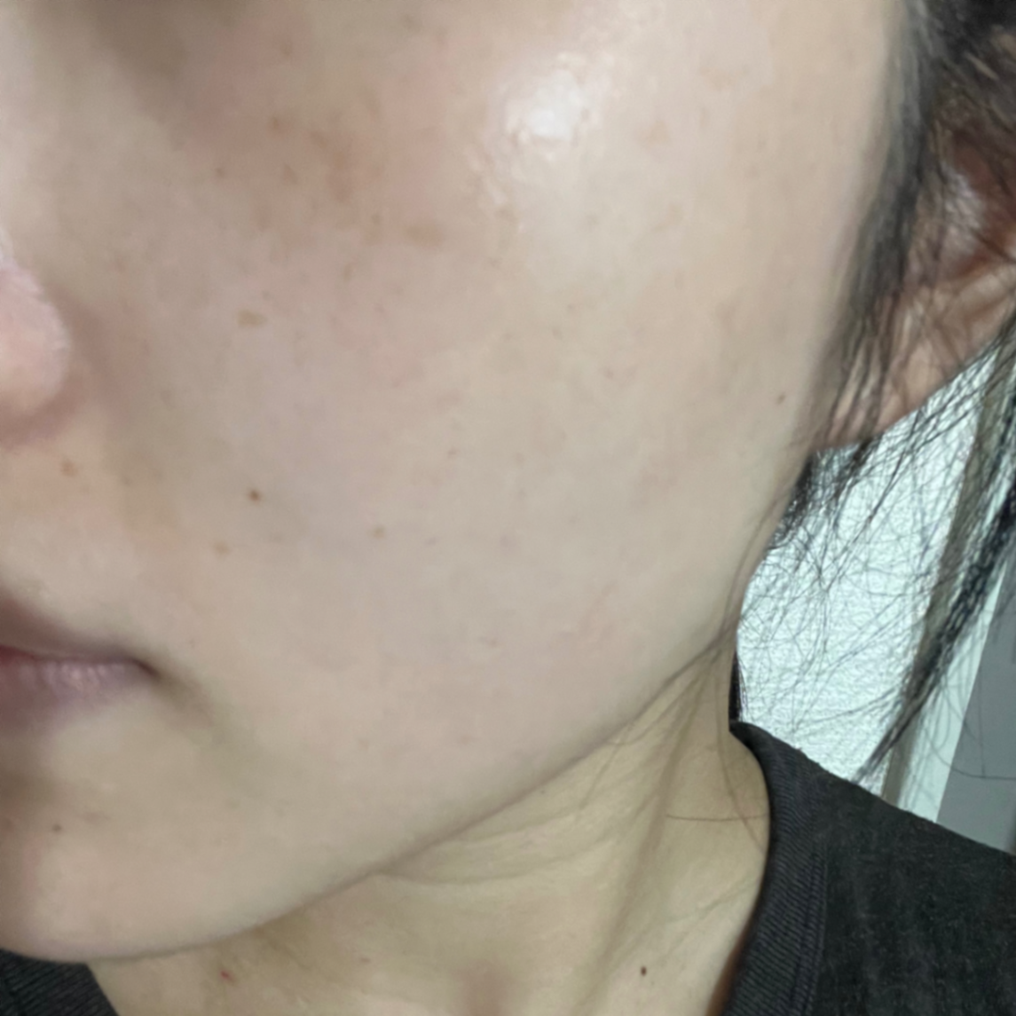 うるおいあふれる素肌へ💧アクシダーム（エレクトロポレーションの口コミ写真