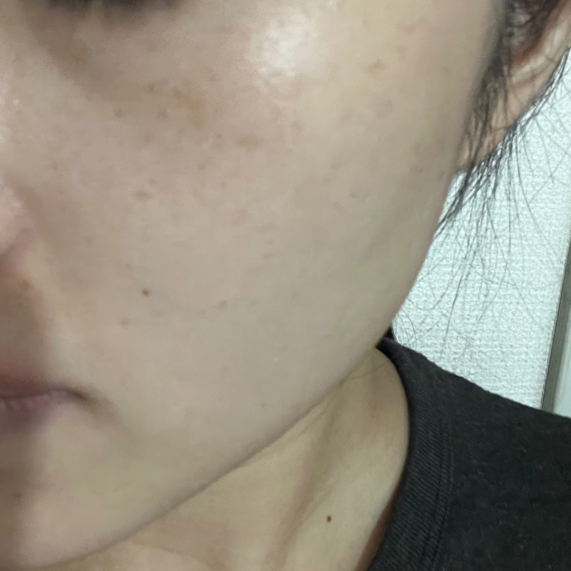 「うるおいあふれる素肌へ💧アクシダーム（エレクトロポレーション」の感想 写真 2