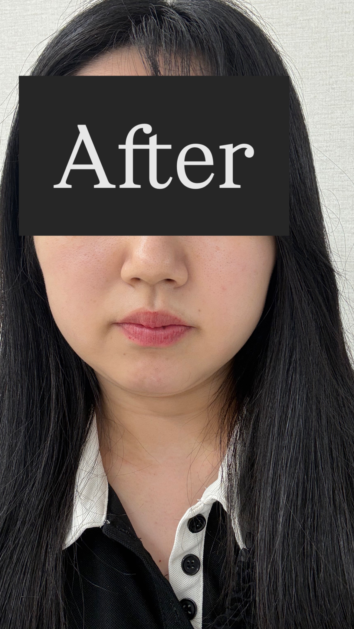 「切らずにリフトアップ💎リフテラV（HIFU）｜顔全体」の感想 写真 3