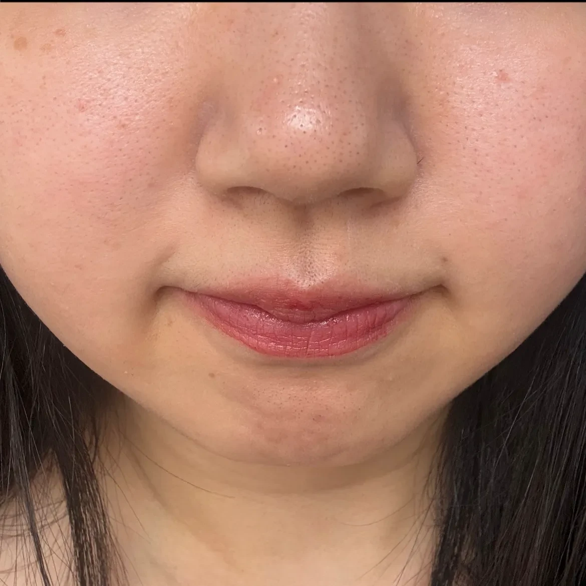 「肝斑を改善し透明感のあるハリ肌へ🌙レーザートーニング｜1回」の感想 写真 2