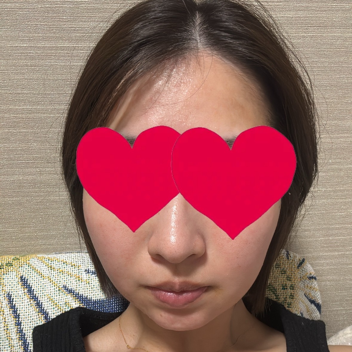 毛穴・キメが気になる方に🪞ダーマペン（顔全体）｜1回の口コミ写真