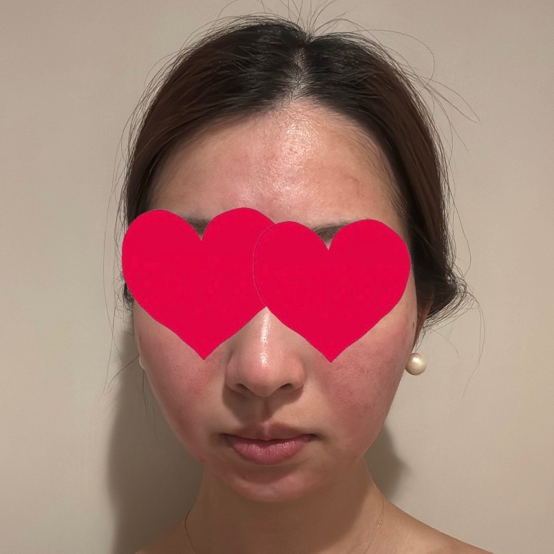 「毛穴レスななめらか肌へ🪞ダーマペン（顔全体）｜1回」の感想 写真 2