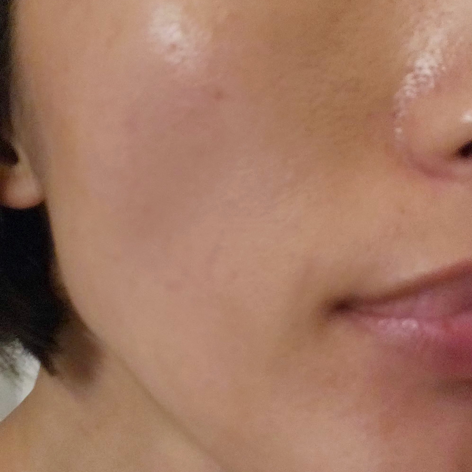 肌の乾燥が気になる方に💧アクシダーム(エレクトロポレーションの口コミ写真