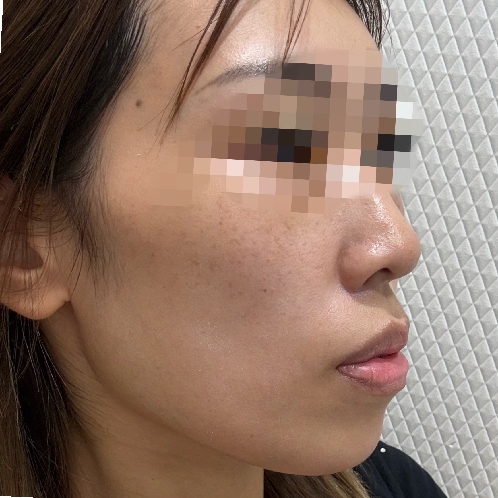 「切らずにリフトアップ💎リフテラV（HIFU）｜あご下〜ほほ」の感想 写真 3