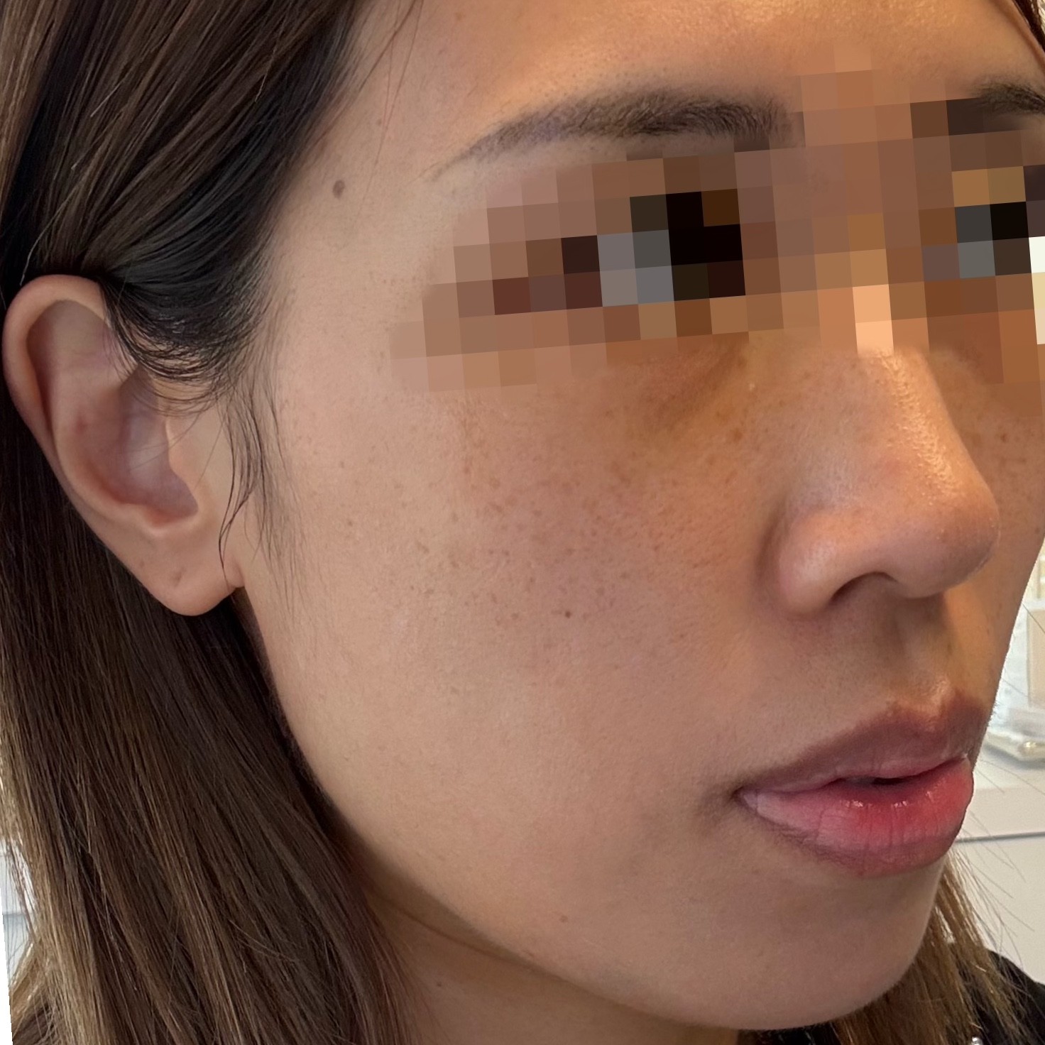 「切らずにリフトアップ💎リフテラV（HIFU）｜あご下〜ほほ」の感想 写真 4