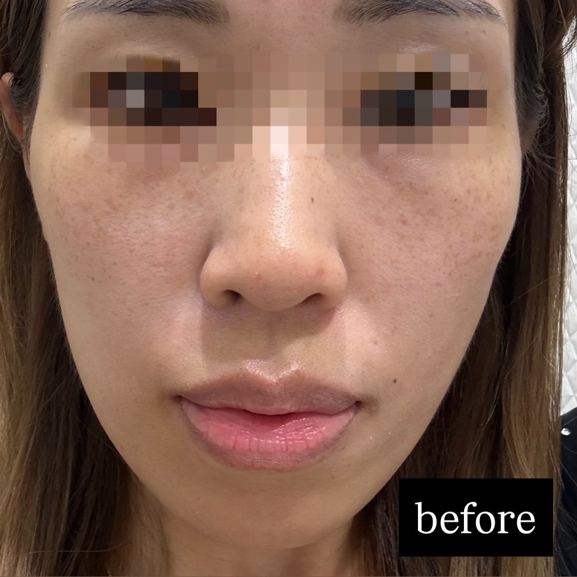 「切らずにリフトアップ💎リフテラV（HIFU）｜あご下〜ほほ」の感想 写真 2