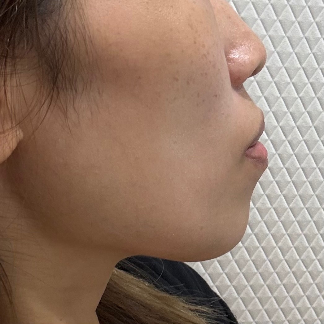 「切らずにリフトアップ💎リフテラV（HIFU）｜あご下〜ほほ」の感想 写真 5