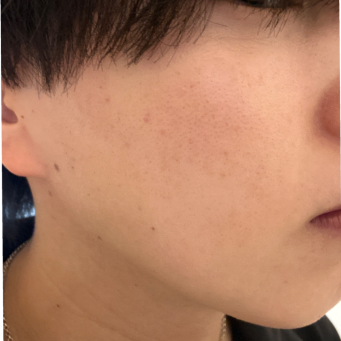 「レーザー×イオン導入で叶えるトータル美肌💙レーザーフェイシャル+イオン導入(ビタミンC)」の感想 写真 1