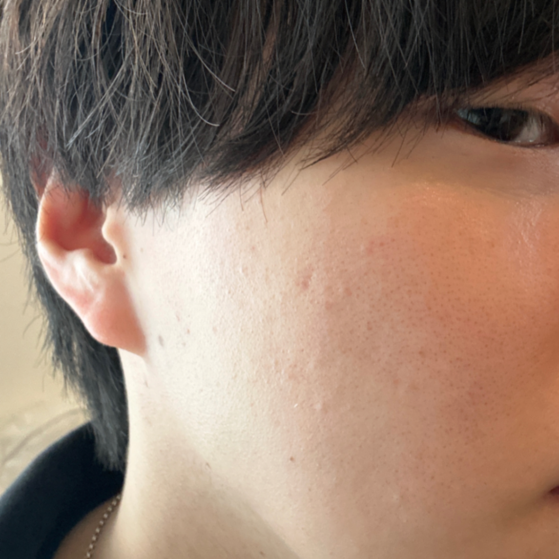 「レーザー×イオン導入で叶えるトータル美肌💙レーザーフェイシャル+イオン導入(ビタミンC)」の感想 写真 2