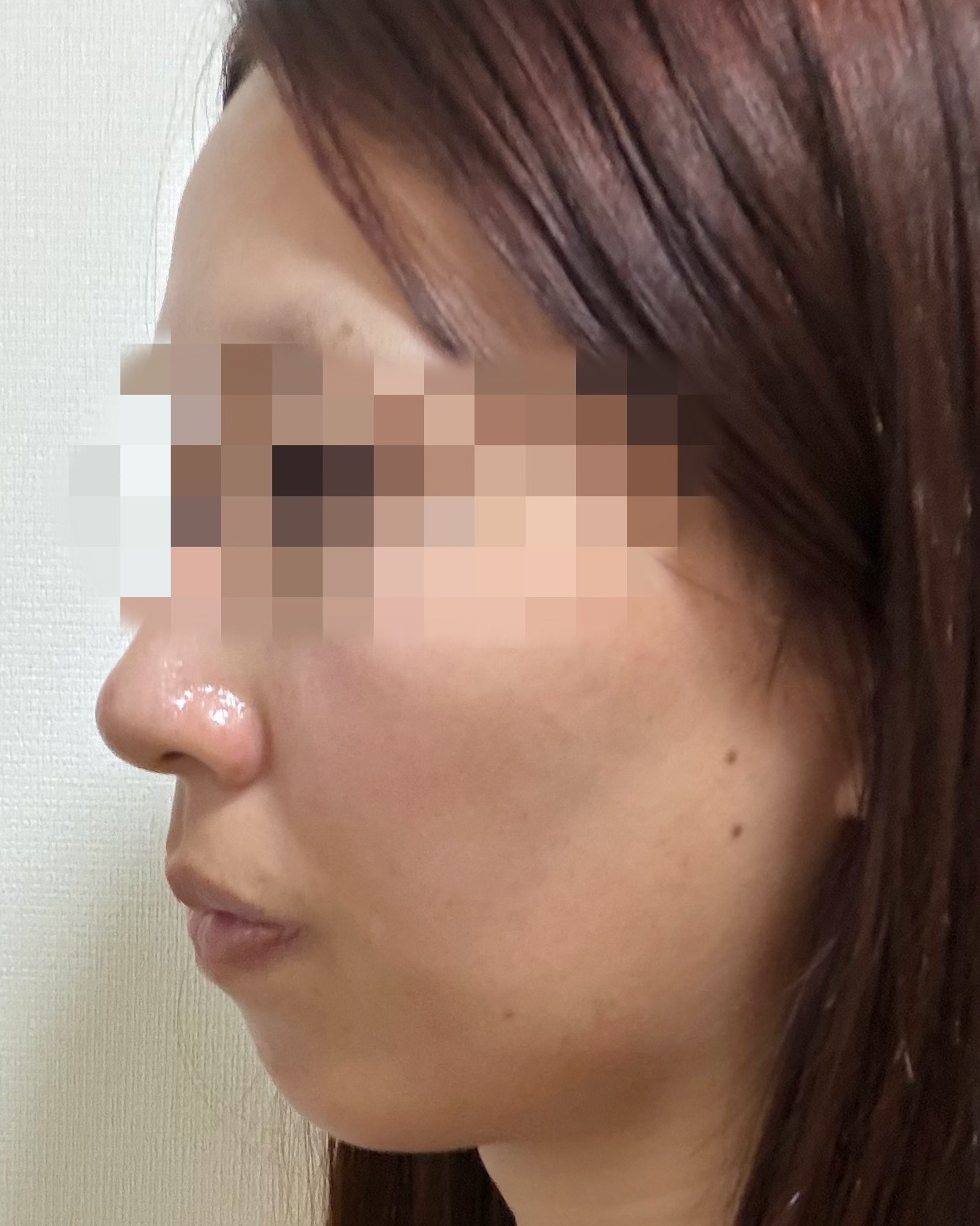 「切らずにリフトアップ💎リフテラV（HIFU）｜あご下〜ほほ」の感想 写真 4