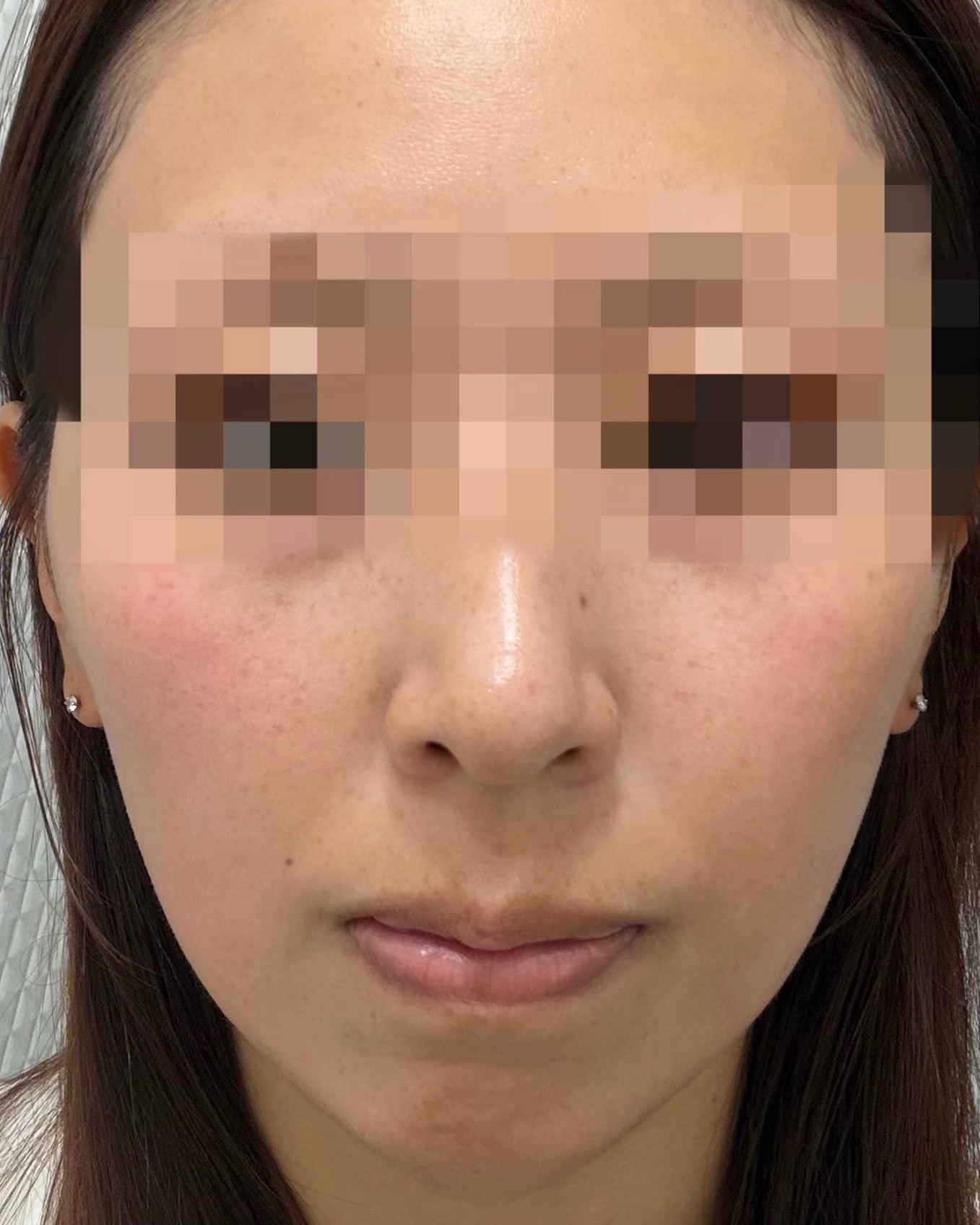「切らずにリフトアップ💎リフテラV（HIFU）｜あご下〜ほほ」の感想 写真 2