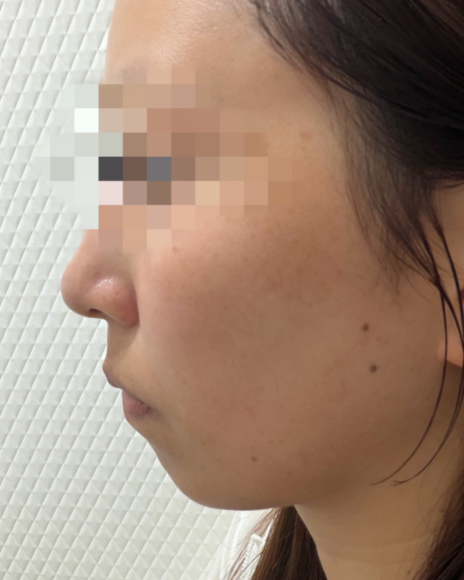 「切らずにリフトアップ💎リフテラV（HIFU）｜あご下〜ほほ」の感想 写真 3