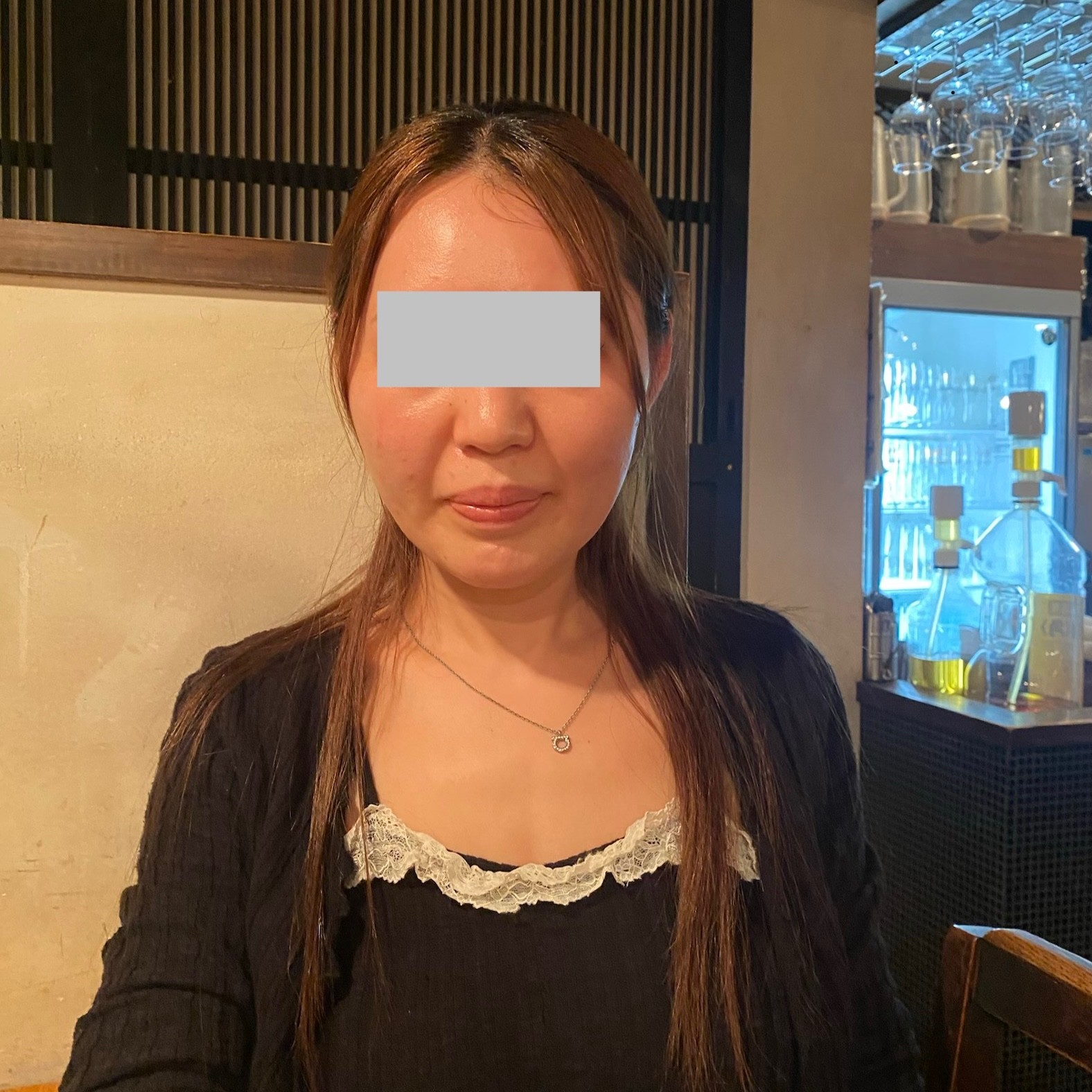 リフテラV(HIFU)|あご下〜ほほの口コミ写真
