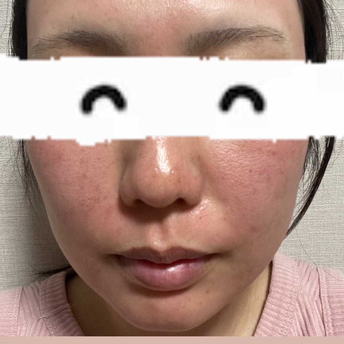 ダーマペン(顔全体)|1回の口コミ写真