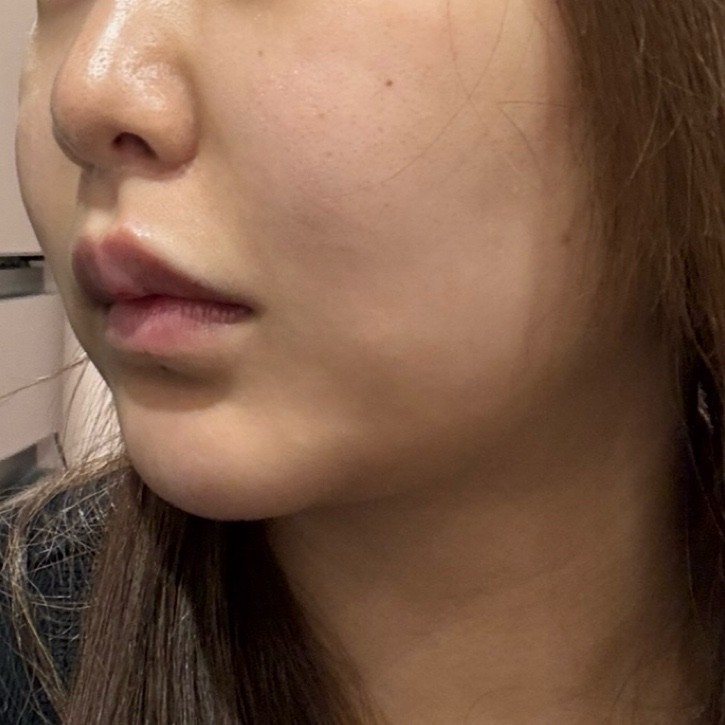 「切らずにリフトアップ💎リフテラV（HIFU）｜あご下〜ほほ」の感想 写真 6