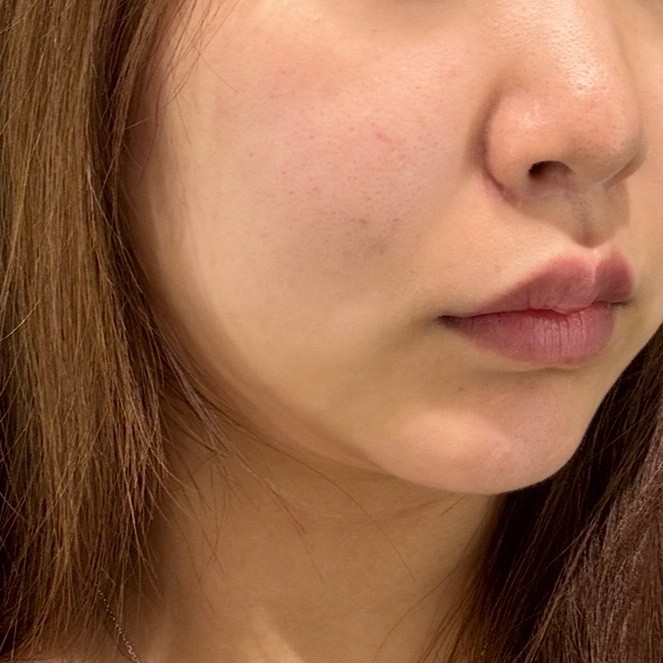 「切らずにリフトアップ💎リフテラV（HIFU）｜あご下〜ほほ」の感想 写真 3