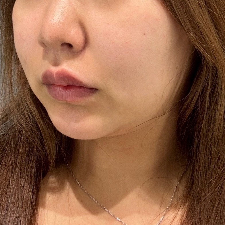 「切らずにリフトアップ💎リフテラV（HIFU）｜あご下〜ほほ」の感想 写真 5