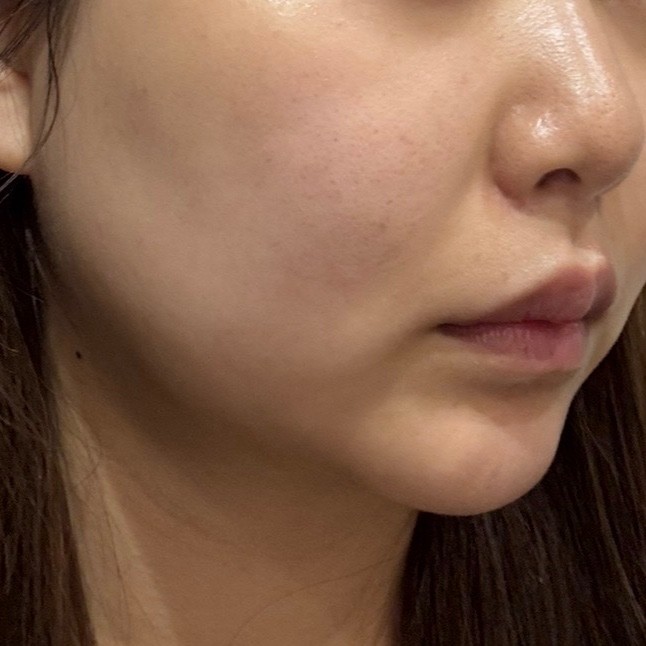 「切らずにリフトアップ💎リフテラV（HIFU）｜あご下〜ほほ」の感想 写真 4