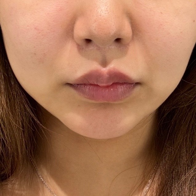 「切らずにリフトアップ💎リフテラV（HIFU）｜あご下〜ほほ」の感想 写真 2
