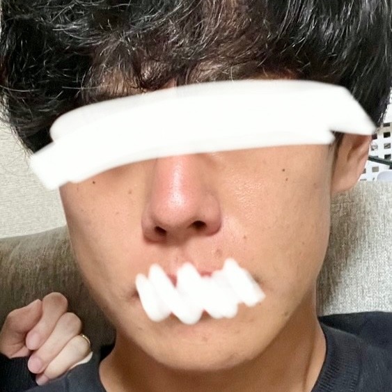 毛穴・キメが気になる方に🪞ダーマペン（顔全体）｜1回の口コミ写真