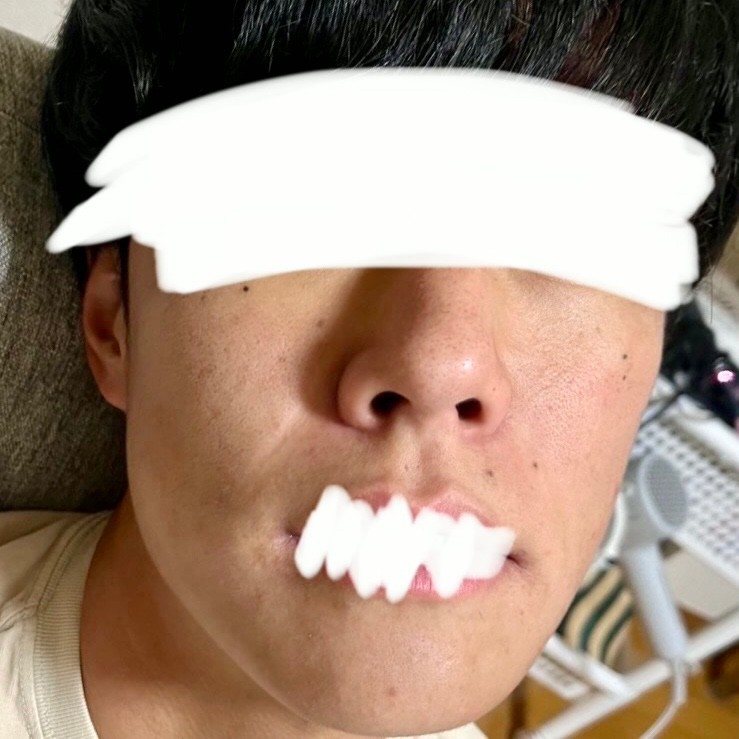 「毛穴レスななめらか肌へ🪞ダーマペン（顔全体）｜1回」の感想 写真 2