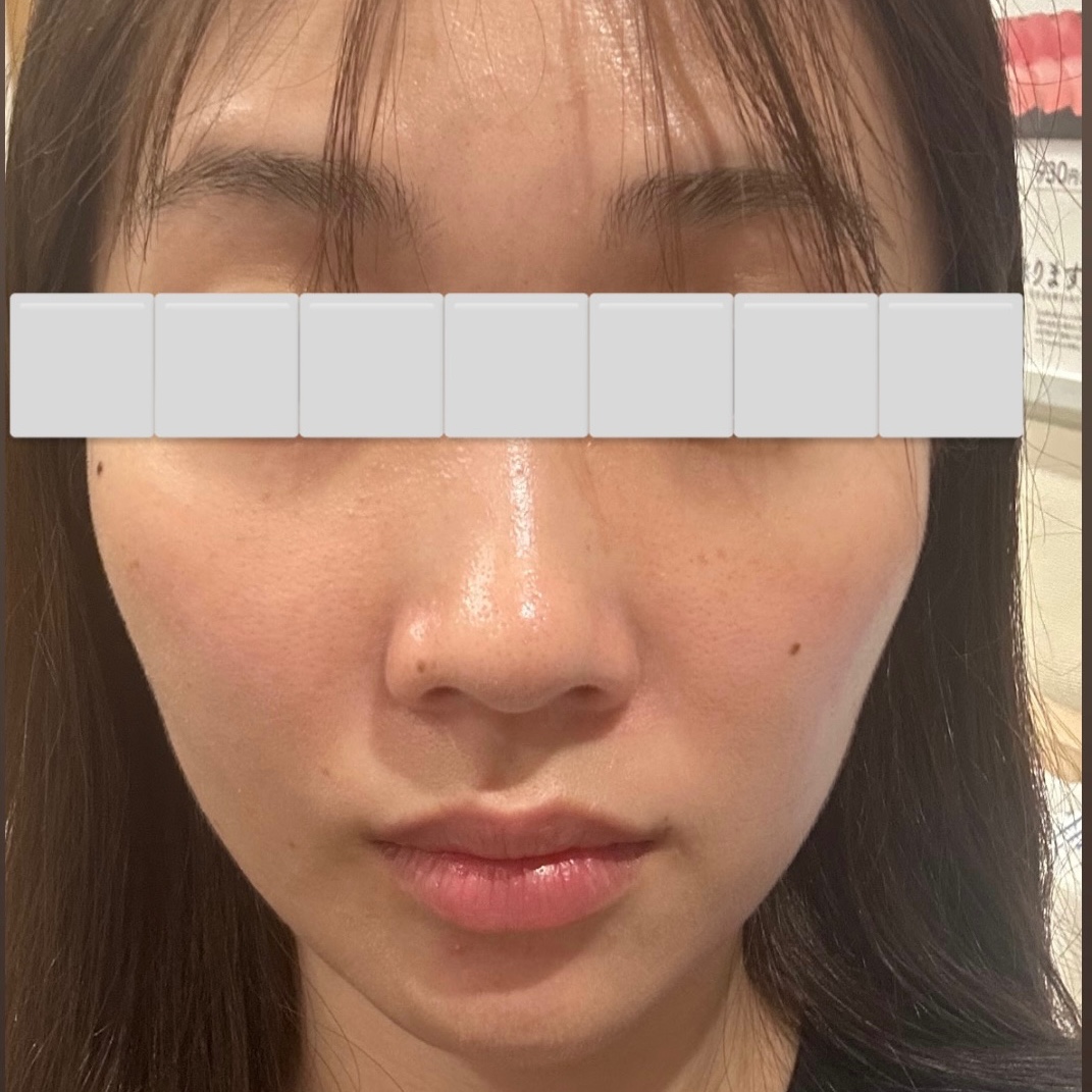 「毛穴レスななめらか肌へ🪞ダーマペン（顔全体）｜1回」の感想 写真 3