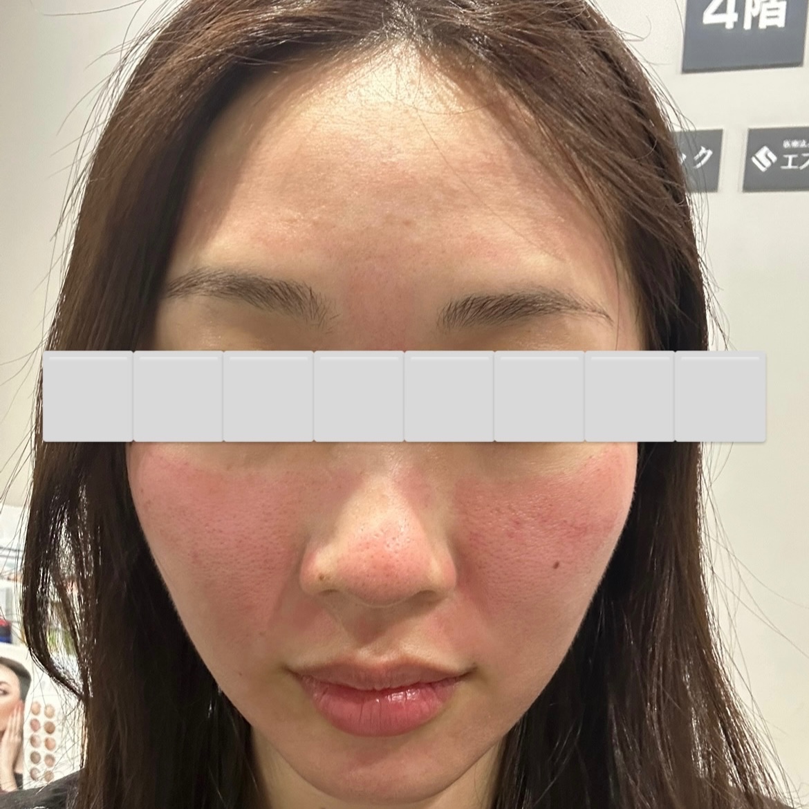 「毛穴レスななめらか肌へ🪞ダーマペン（顔全体）｜1回」の感想 写真 4